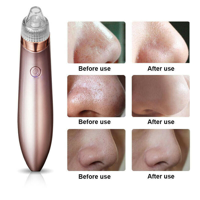 Aspirateur électrique pour points noirs et pores, élimine l'acné et les boutons, outil d'aspiration puissant, élimine les points noirs et les pores, dermabrasion au diamant, nettoyant pour le visage